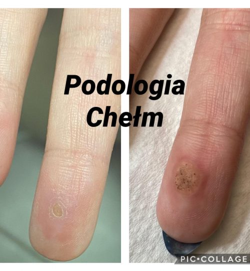 Zabiegi podologiczne